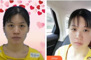 邯鄲貝潔口腔醫(yī)院李東娟整形價格表附眼部綜合案例展示