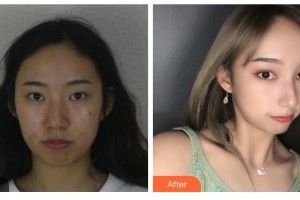 邯鄲愛爾眼科醫(yī)院王炳亮整形價格表附眼部綜合案例展示