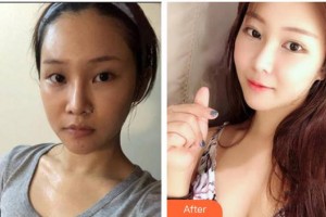 漢口愛爾眼科醫(yī)院曾慶延整形價格表附眼部綜合案例展示