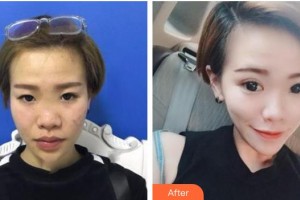 漢口愛爾眼科醫(yī)院范文雨整形價格表附眼部綜合案例展示