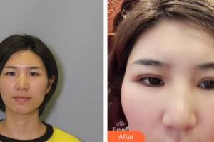 漢口愛爾眼科醫(yī)院喬晨整形價格表附眼部綜合案例展示