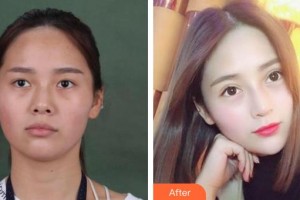 漢口愛爾眼科醫(yī)院譚維娜整形價格表附切開雙眼皮案例展示