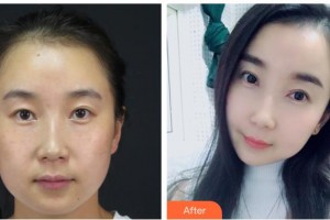 漢口愛爾眼科醫(yī)院諶丹整形價格表附眼部綜合案例展示