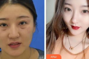 漢口愛爾眼科醫(yī)院杜芳整形價格表附激光去眼袋案例展示