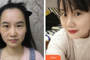 漢口愛爾眼科醫(yī)院吳立平整形價格表附眼部綜合案例展示