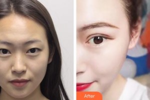 漢口愛爾眼科醫(yī)院鄭亦君整形價格表附切開雙眼皮案例展示