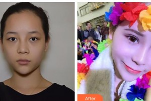 漢口愛爾眼科醫(yī)院陳華整形價格表附切開雙眼皮案例展示