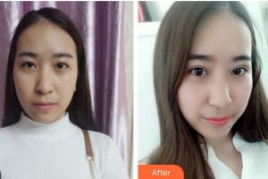 漢口愛爾眼科醫(yī)院劉俊杰整形價格表附埋線雙眼皮案例展示