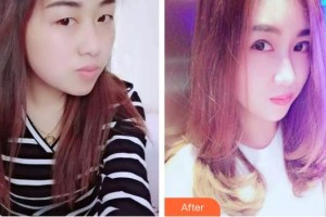 湘西麗人整形美容醫(yī)院徐娟整形價格表附切開雙眼皮案例展示