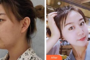 湘西愛爾眼科醫(yī)院譚米特整形價格表附眼部綜合案例展示