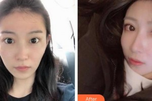 湘西愛爾眼科醫(yī)院田明整形價格表附眼部綜合案例展示