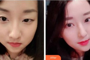 汕頭國際眼科中心張銘志整形價格表附定點雙眼皮案例展示