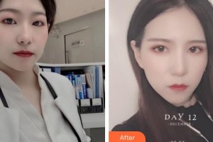 深圳德視佳眼科門診部姚文琴整形價格表附切開雙眼皮案例展示