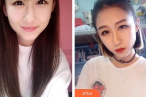 深圳市眼科醫(yī)院杜冰整形價格表附切開雙眼皮案例展示