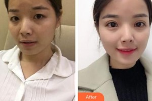 深圳市眼科醫(yī)院陳璐整形價(jià)格表附切開(kāi)雙眼皮案例展示