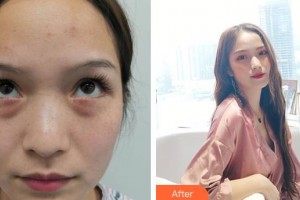 深圳德視佳眼科門(mén)診部賀純純整形價(jià)格表附激光去眼袋案例展示