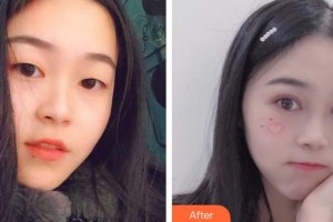 深圳市眼科醫(yī)院賀溫玲整形價(jià)格表附切開(kāi)雙眼皮案例展示