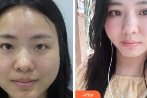 深圳市眼科醫(yī)院聶丹瑤整形價格表附激光去眼袋案例展示