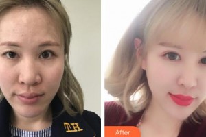 深圳市眼科醫(yī)院陳青山整形價格表附眼部綜合案例展示