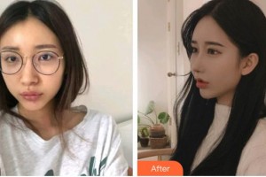 深圳市眼科醫(yī)院梁思穎整形價(jià)格表附眼部綜合案例展示