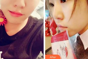 深圳市眼科醫(yī)院張國(guó)明整形價(jià)格表附切開(kāi)雙眼皮案例展示