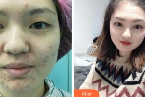 深圳希瑪林順潮眼科醫(yī)院林順潮整形價(jià)格表附眼部綜合案例展示