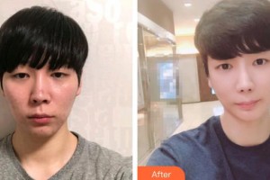 深圳愛(ài)爾眼科醫(yī)院林晨整形價(jià)格表附眼部修復(fù)案例展示