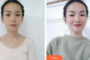 深圳愛(ài)爾眼科醫(yī)院黃麗娜整形價(jià)格表附埋線雙眼皮案例展示