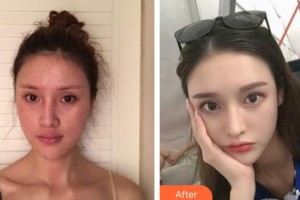 深圳德視佳眼科門診部張平整形價(jià)格表附下瞼整形案例展示