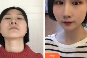 深圳愛(ài)爾眼科醫(yī)院陳炳衡整形價(jià)格表附眼部綜合案例展示