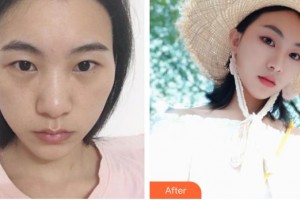 深圳愛(ài)爾眼科醫(yī)院金童實(shí)整形價(jià)格表附眼部綜合案例展示