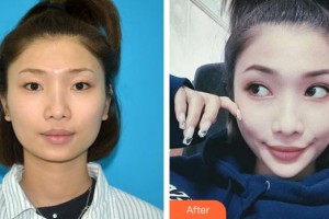 深圳愛(ài)爾眼科醫(yī)院鐘華紅整形價(jià)格表附內(nèi)切祛眼袋案例展示