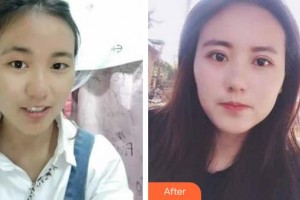 深圳愛(ài)爾眼科醫(yī)院慕明燕整形價(jià)格表附切開雙眼皮案例展示