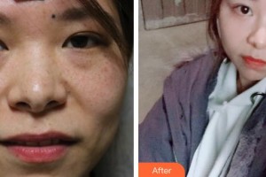 深圳市眼科醫(yī)院聞慧整形價(jià)格表附激光去眼袋案例展示