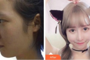 深圳愛(ài)爾眼科醫(yī)院徐超然整形價(jià)格表附切開雙眼皮案例展示