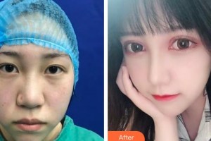 深圳愛(ài)爾眼科醫(yī)院馬慧明整形價(jià)格表附切開雙眼皮案例展示