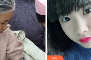 深圳愛(ài)爾眼科醫(yī)院柯妍整形價(jià)格表附切開雙眼皮案例展示