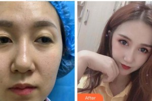 深圳愛(ài)爾眼科醫(yī)院李敏超整形價(jià)格表附眼部綜合案例展示