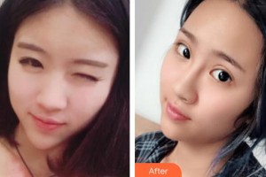 深圳愛(ài)爾眼科醫(yī)院成躍偉整形價(jià)格表附內(nèi)切祛眼袋案例展示