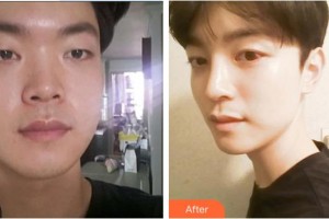 深圳愛(ài)爾眼科醫(yī)院易細(xì)香整形價(jià)格表附眼部綜合案例展示