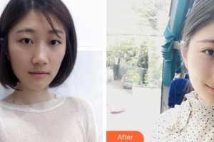 深圳愛(ài)爾眼科醫(yī)院楊化學(xué)整形價(jià)格表附定點(diǎn)雙眼皮案例展示