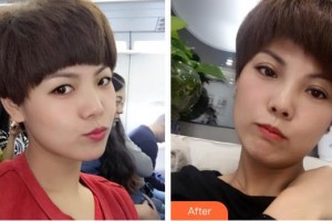 深圳愛(ài)爾眼科醫(yī)院胡尊霞整形價(jià)格表附定點(diǎn)雙眼皮案例展示