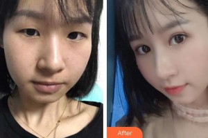 深圳愛(ài)爾眼科醫(yī)院凌受良整形價(jià)格表附切開雙眼皮案例展示