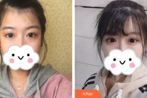 深圳愛(ài)爾眼科醫(yī)院謝金榮整形價(jià)格表附眼部綜合案例展示