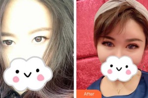 深圳愛(ài)爾眼科醫(yī)院尹海泉整形價(jià)格表附眼部綜合案例展示