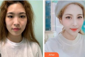 深圳愛(ài)爾眼科醫(yī)院周月芷整形價(jià)格表附眼部綜合案例展示