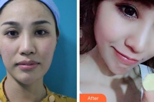 深圳愛(ài)爾眼科醫(yī)院胡珊整形價(jià)格表附眼部綜合案例展示