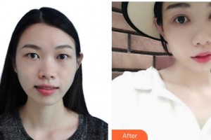 深圳?，斄猪槼毖劭漆t(yī)院施禮康整形價(jià)格表附切開雙眼皮案例展示