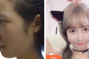 深圳愛(ài)爾眼科醫(yī)院李肖娟整形價(jià)格表附眼部綜合案例展示