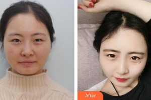 深圳?，斄猪槼毖劭漆t(yī)院肖月影整形價(jià)格表附眼部修復(fù)案例展示